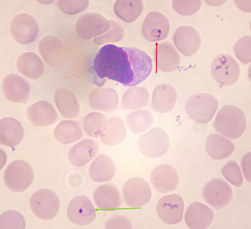 (溶血瑞氏吉姆萨染色,放大1000倍镜检)图15 恶性疟原虫感染患者厚血膜