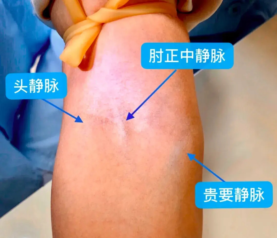 扎压脉带---轻握拳---轻拍打预期穿刺部位