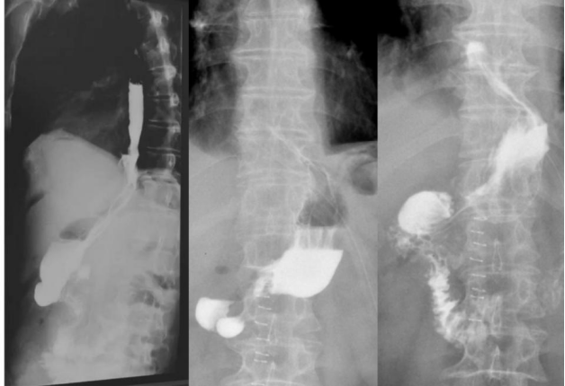 建院20年|哈医大四院普外科一病房熟练开展"完全腹腔镜下近端胃癌根治