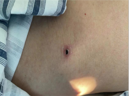 最终确诊为重症恙虫病