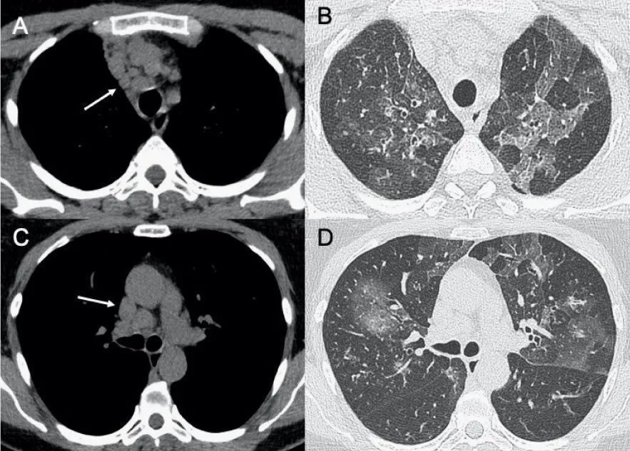 图(a,c)显示纵隔淋巴结肿大(箭头),与双肺局灶性小叶ggo相关(b,d).