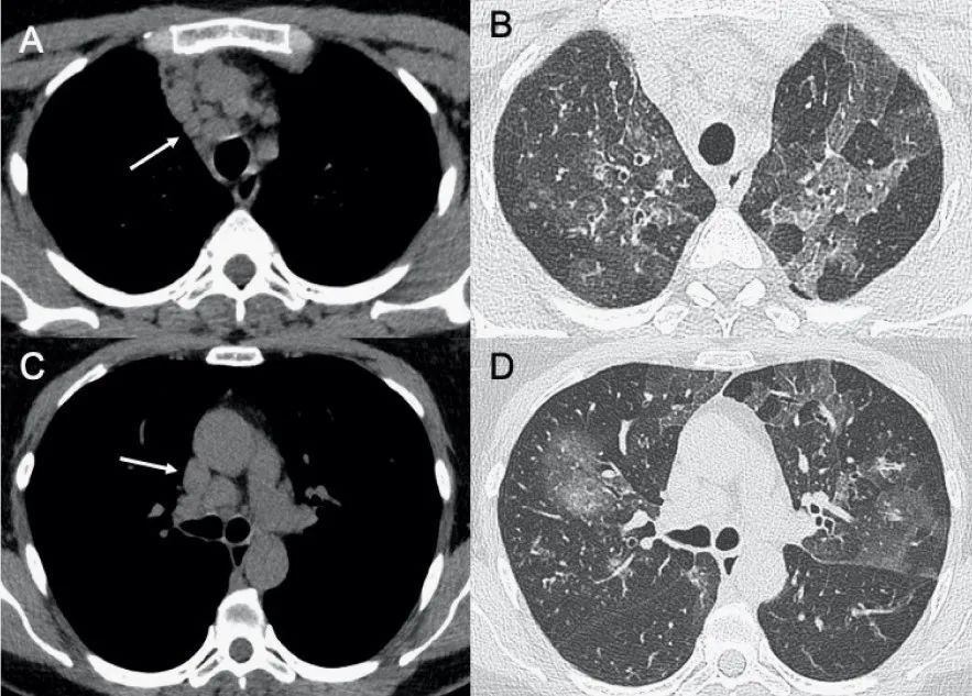 常见病毒性肺炎的影像学特征︱图文并茂