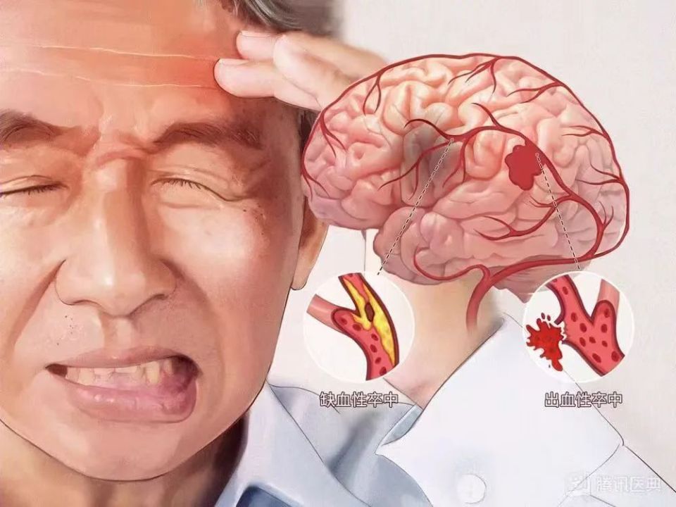脑卒中,也叫"中风",是由于脑血管堵塞或破裂导致的疾病,分为两种类型