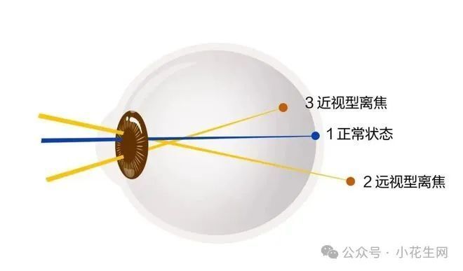 14岁娃3年离焦镜经验：半路“退轴”，近视几乎没涨！_腾讯新闻