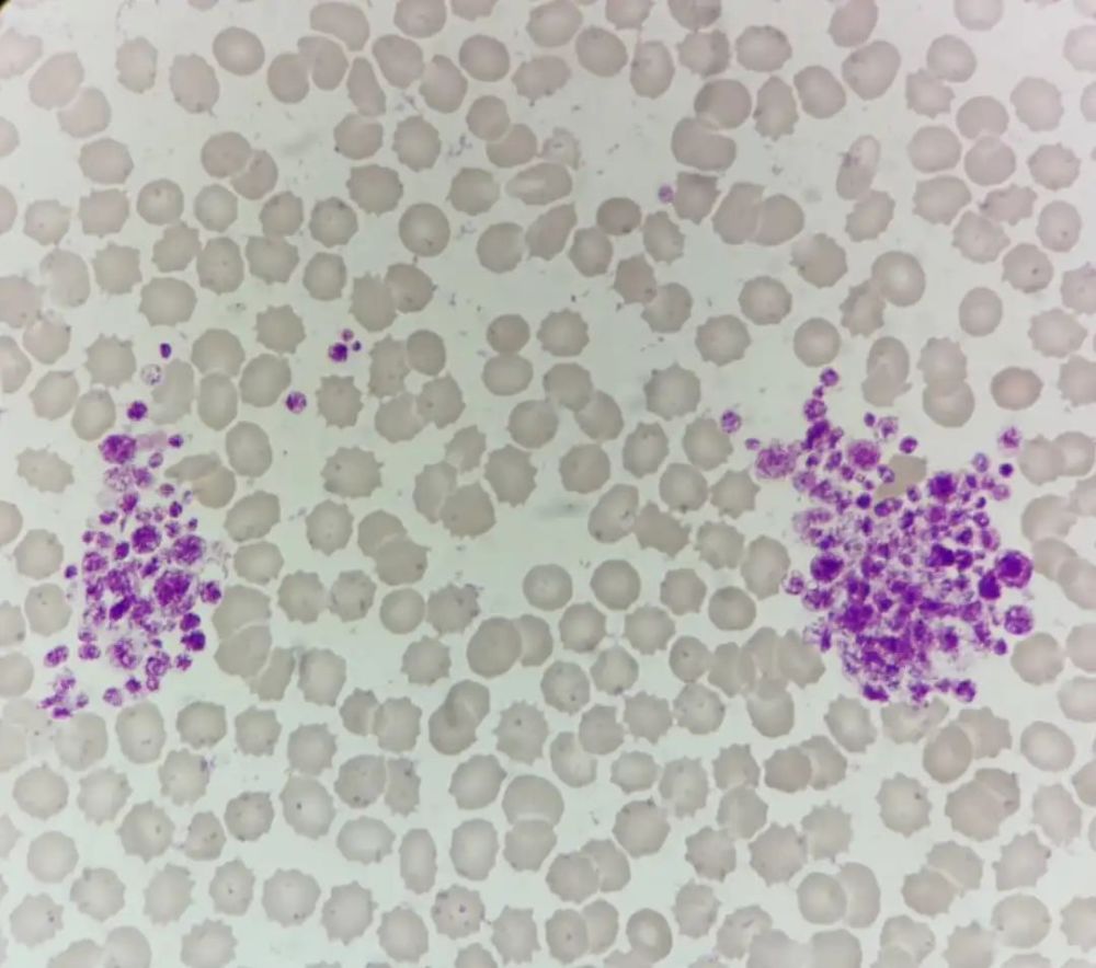 外周血塗片白細胞血小板同時聚集什麼情況