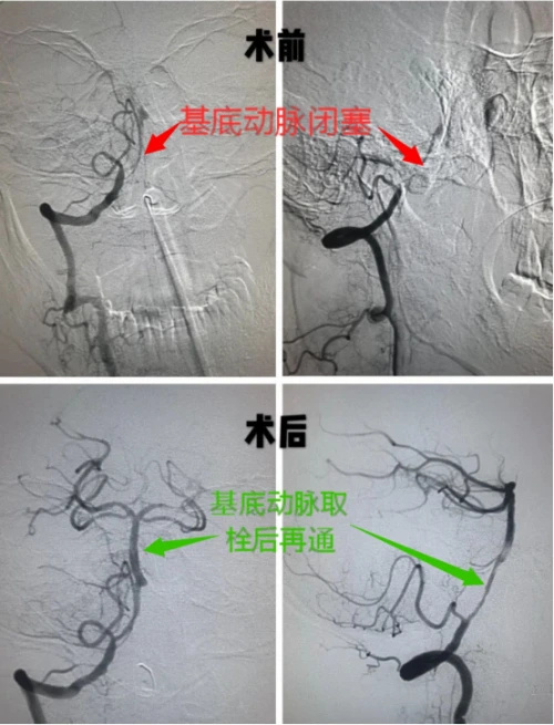 颅底动脉硬化图片