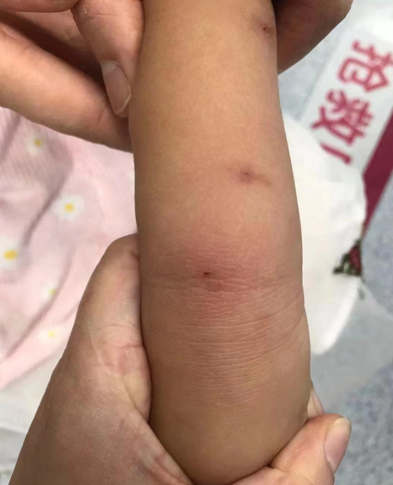 8岁男孩浑身被蜂蜇近10处伤专家户外出游这些提醒要记牢