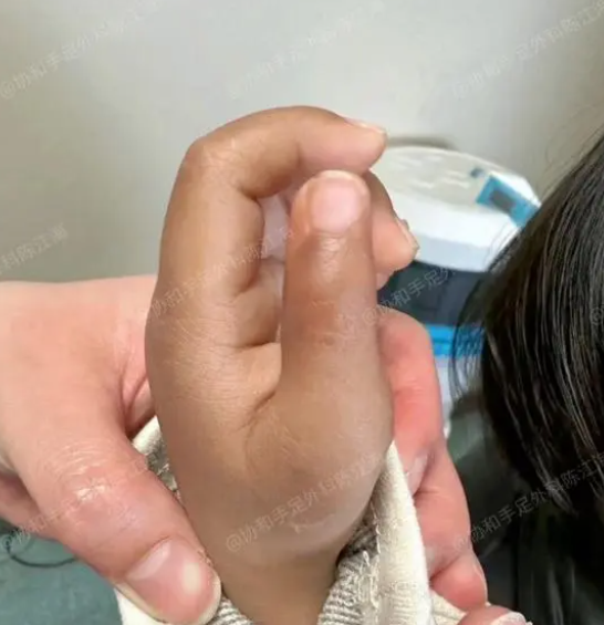 孩子出生左手六指像蟹钳跑了2次医院最后拇指总算正常了