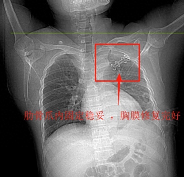 长沙县一建筑工地突发意外！杨师傅高处坠落