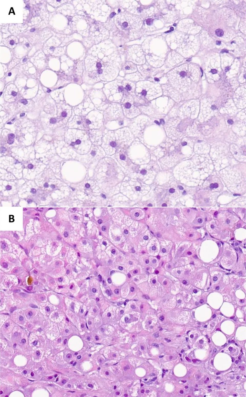 认识酒精性泡沫样肝脂肪变性,千万别再误诊为酒精性肝炎了!