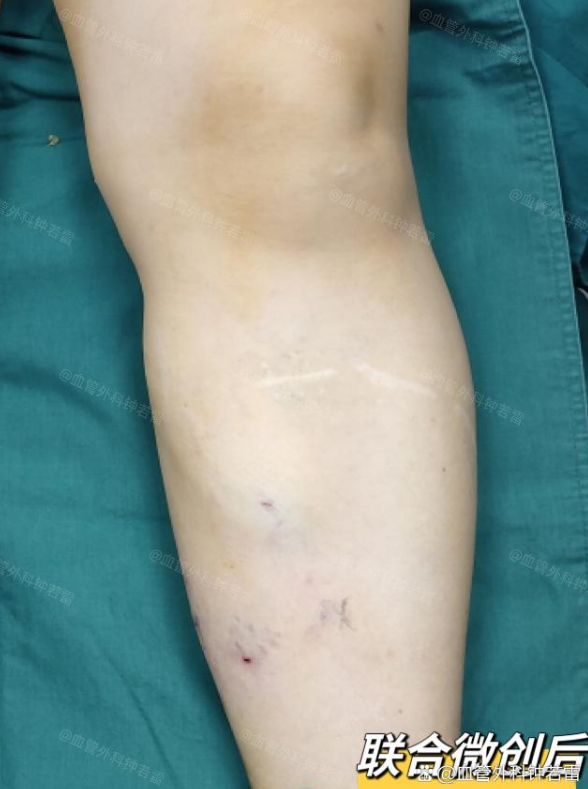53岁大姐静脉曲张微创9个月后,腿上几乎看不出痕迹