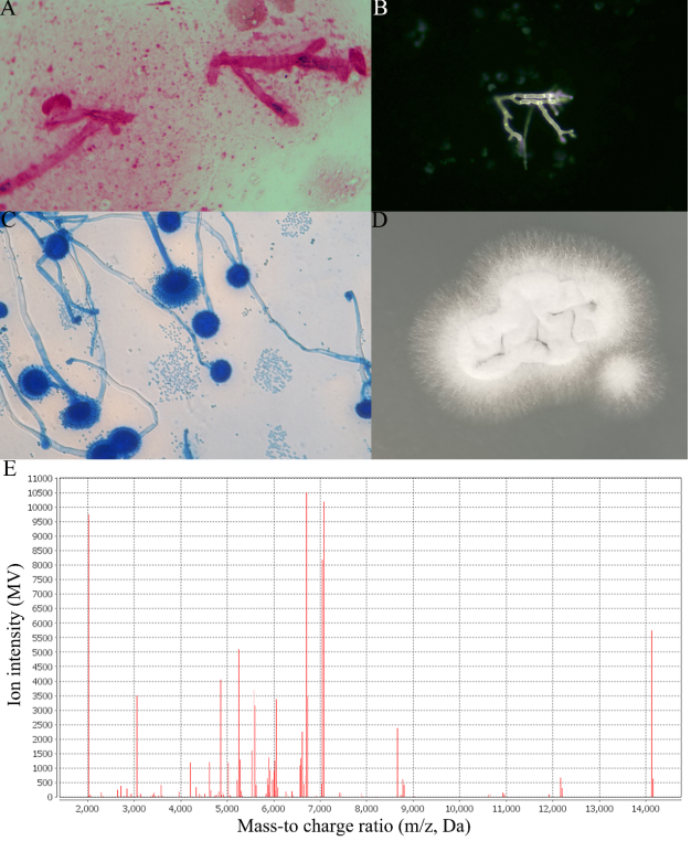 一例"非典型"患者的启示:对变应性支气管肺曲霉病