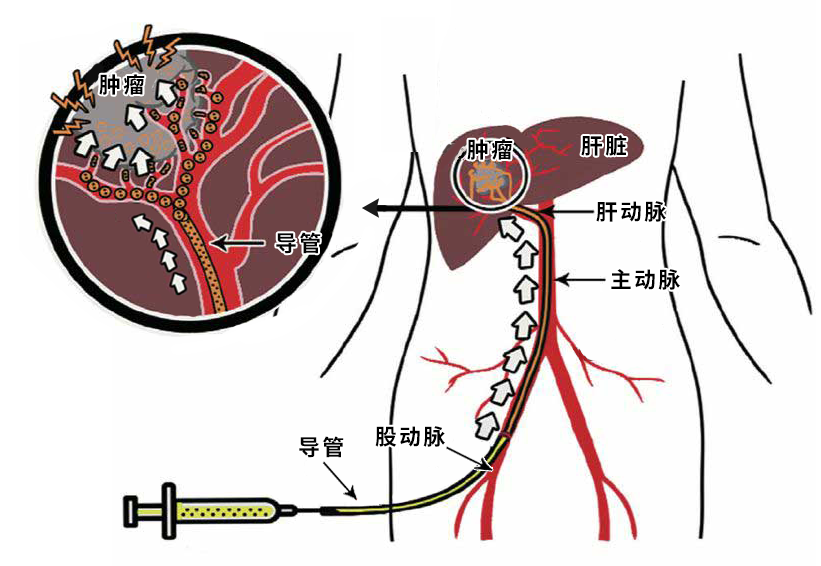 肝癌介入栓塞图片图片