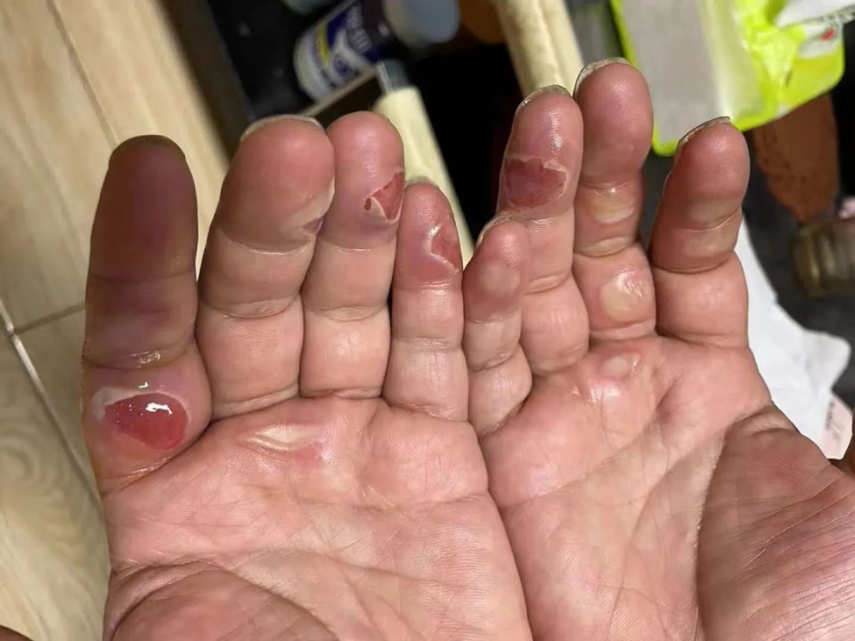 谋"更多的是为他点赞除了心疼手的主人"心疼这双手""十指连心,疼死了!