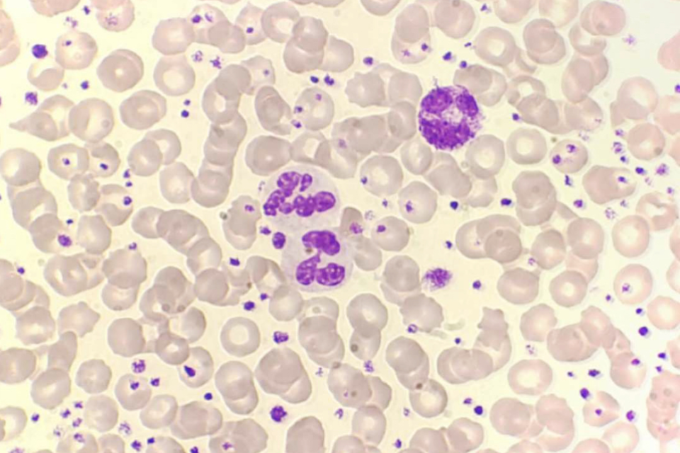 血小板增多揪出慢性白血病