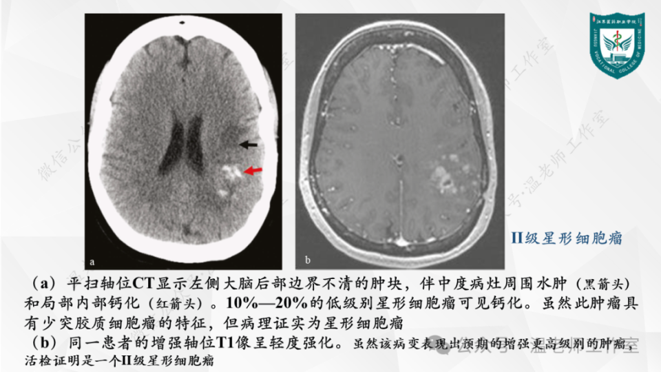 大脑镰脂肪瘤影像表现图片