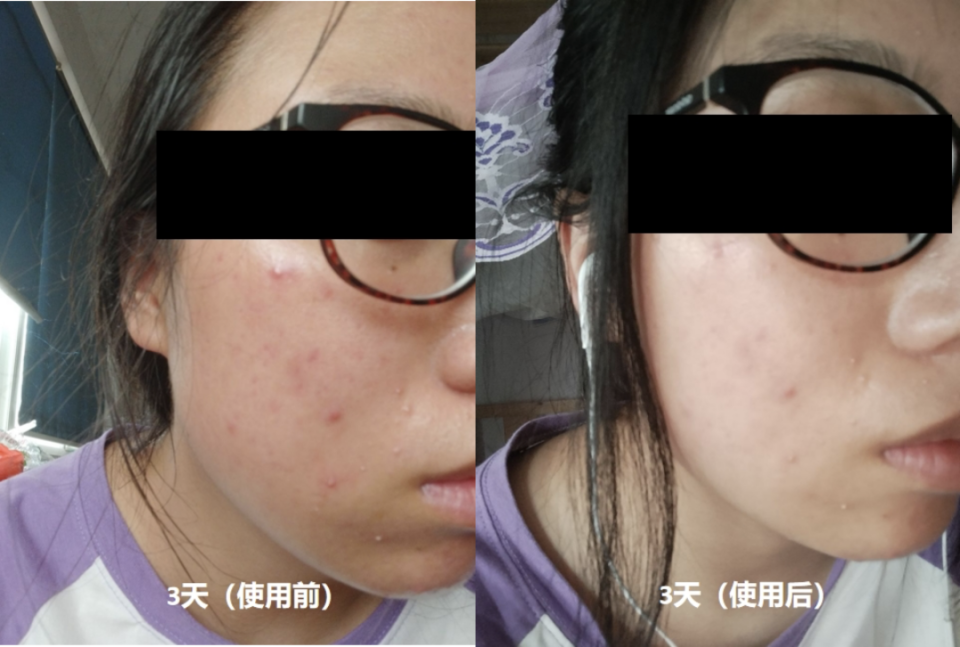 果壳实拍73丹皮酚配合互生叶白千层提取物,对红痘痘起到一定的镇静