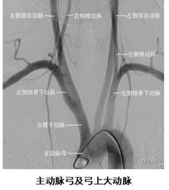 脑血管病的血管内介入诊断:全脑血管造影术的全面解析