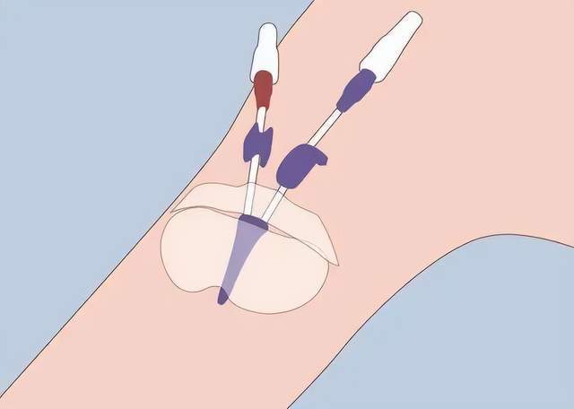 挂个picc门诊就够了!_腾讯新闻