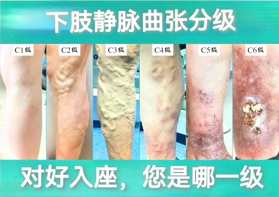如何预防下肢静脉曲张?听听广东医东莞附一院专家怎么