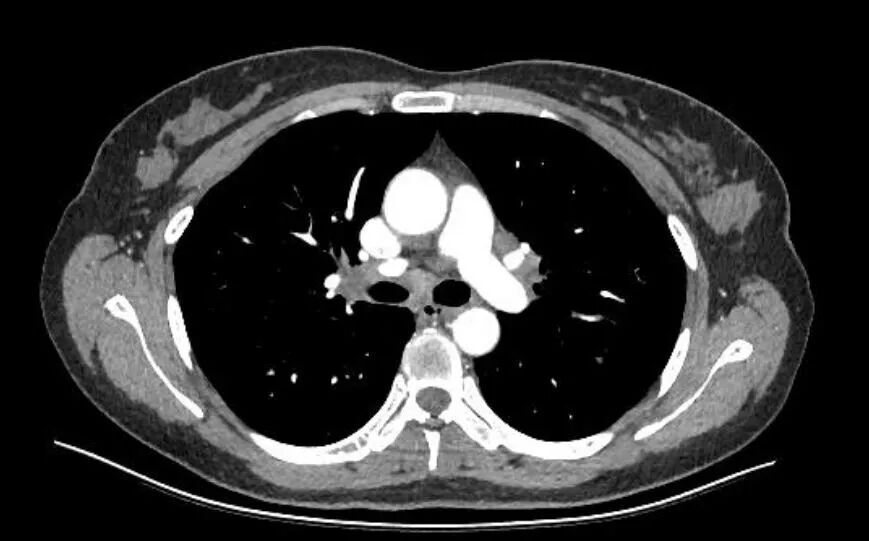 2026年美国结节病治疗新趋势：非甾体免疫抑制剂成新宠