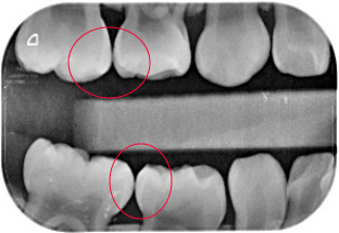 健康的牙缝牙缝出现早期邻面龋为什么叫咬合翼片呢?