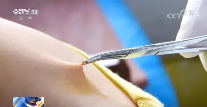 由于蜱虫的口器部分有倒刺,刺入皮肤吸血后很难拔出.