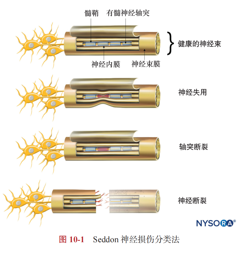 外周神经阻滞的神经系统并发症_腾讯新闻