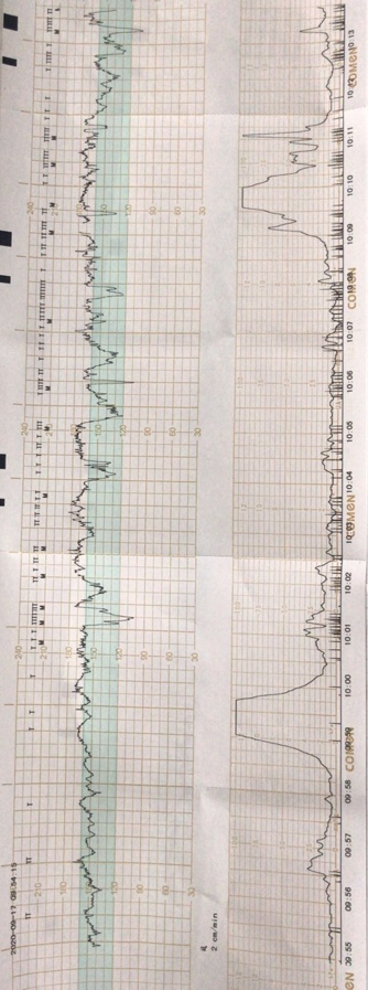 胎心监护不会看?一见减速就说胎儿窘迫?3 分钟教会你胎监解读