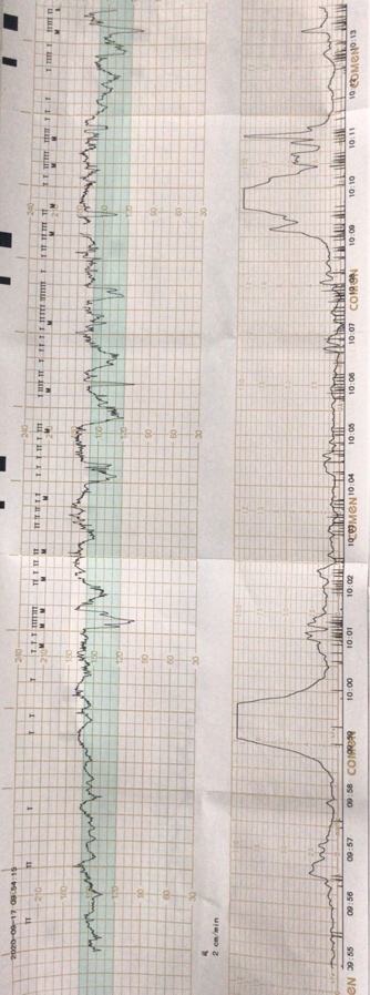 规律宫缩胎心监护图图片