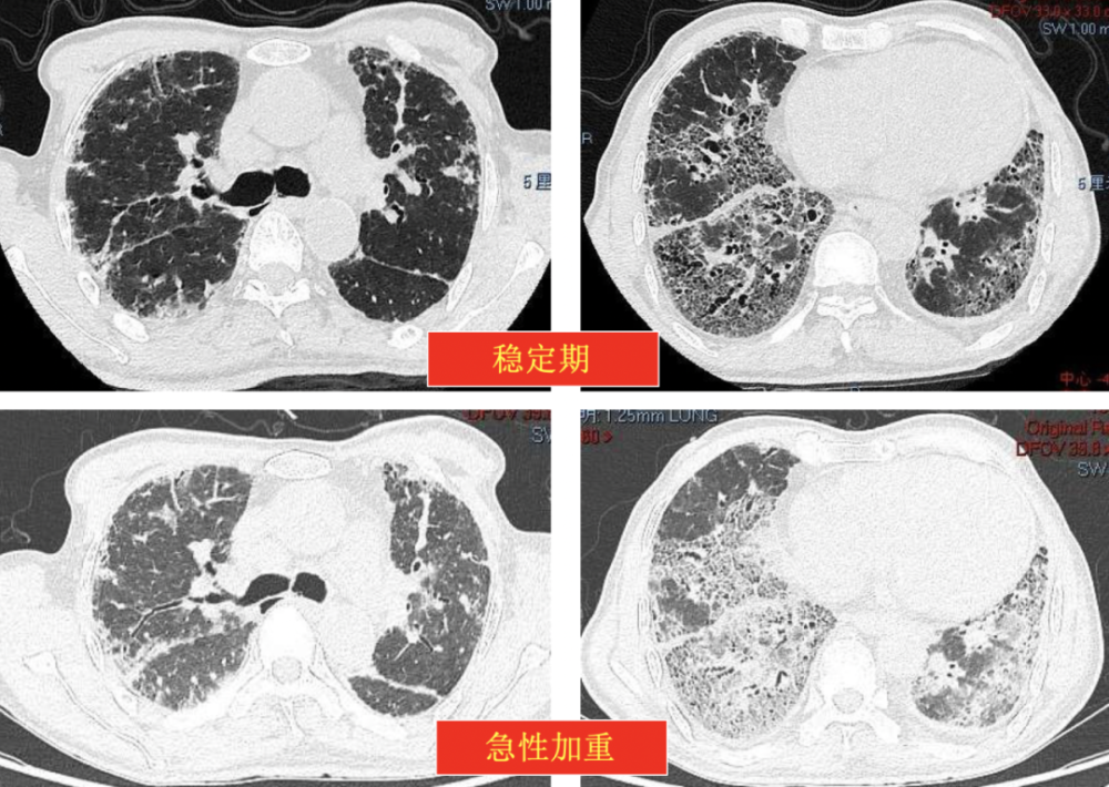 肺组织纤维化图片