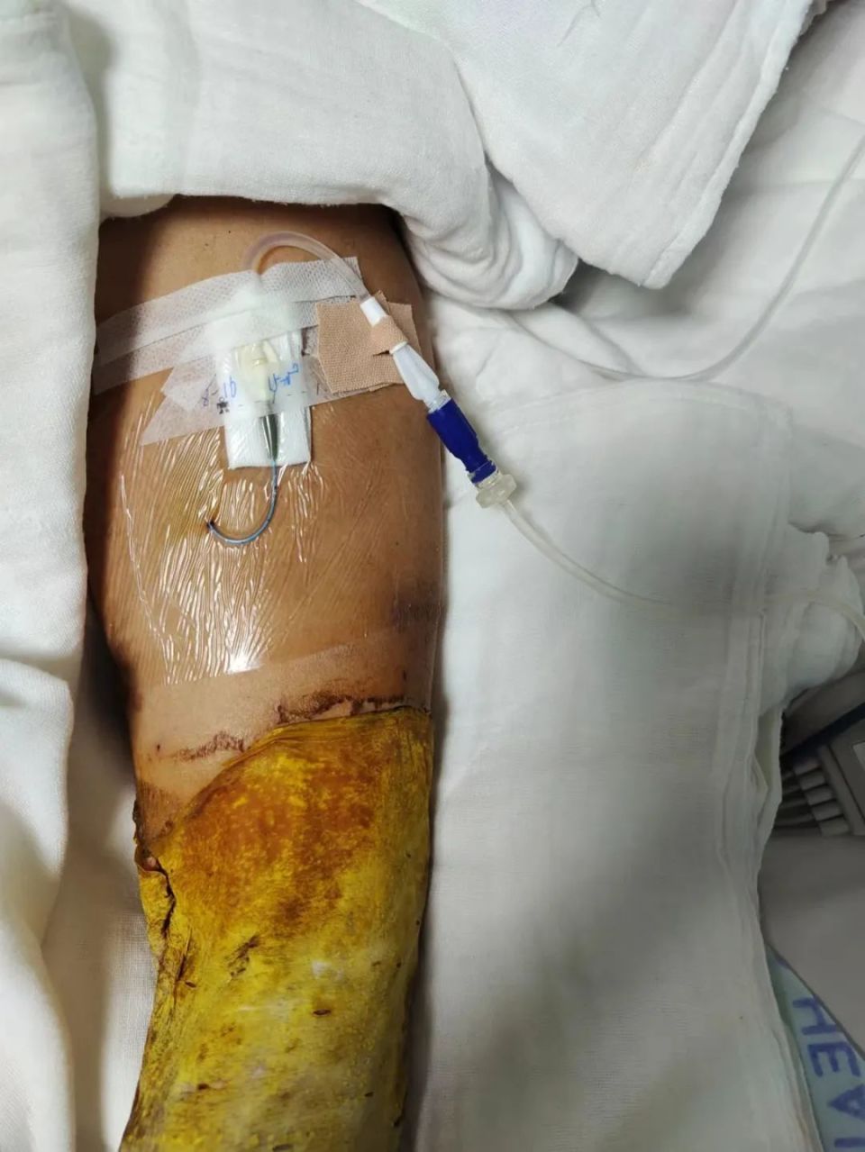 改良型中等长度导管助力患者快速康复