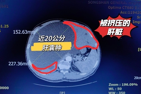 20cm肝囊肿"挤压"肝脏 松山医院超微创手术顺利引流
