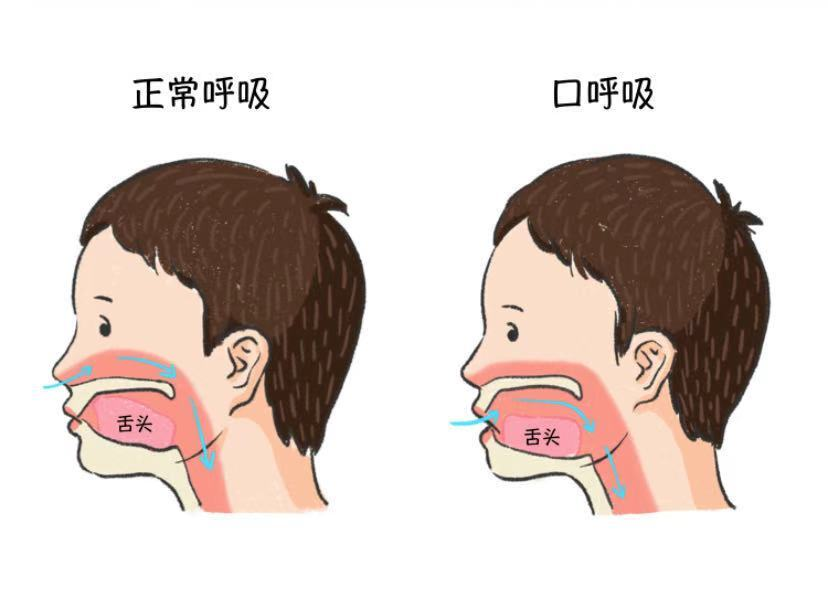 硬腭高拱图片图片