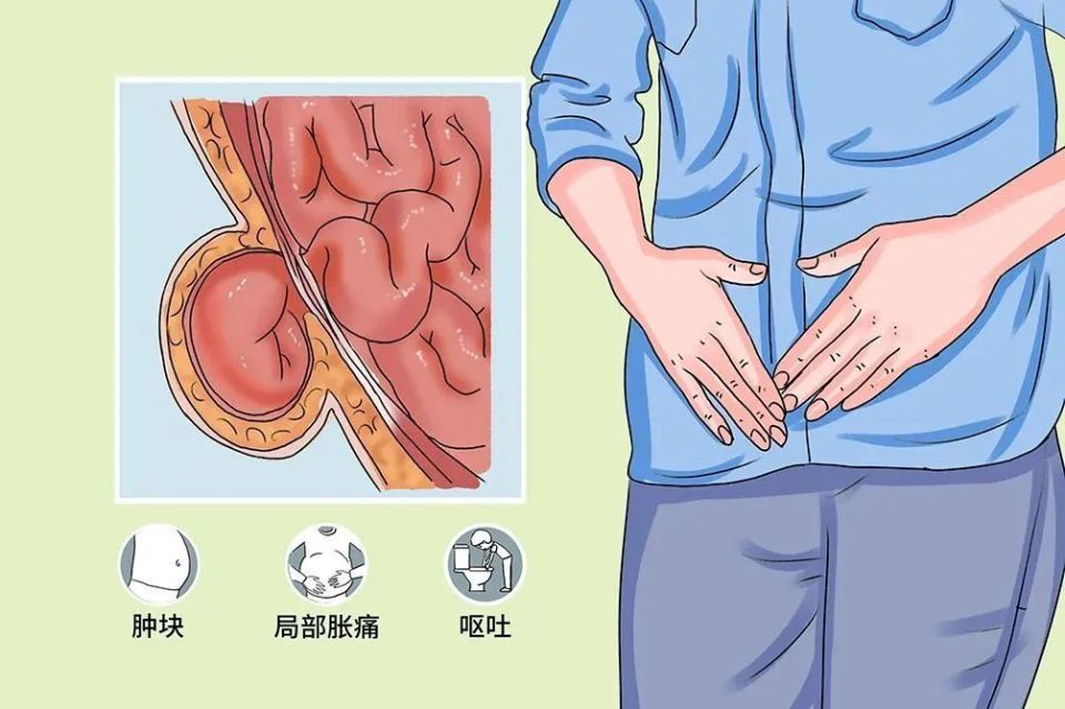 肠痉挛在哪个位置图片图片