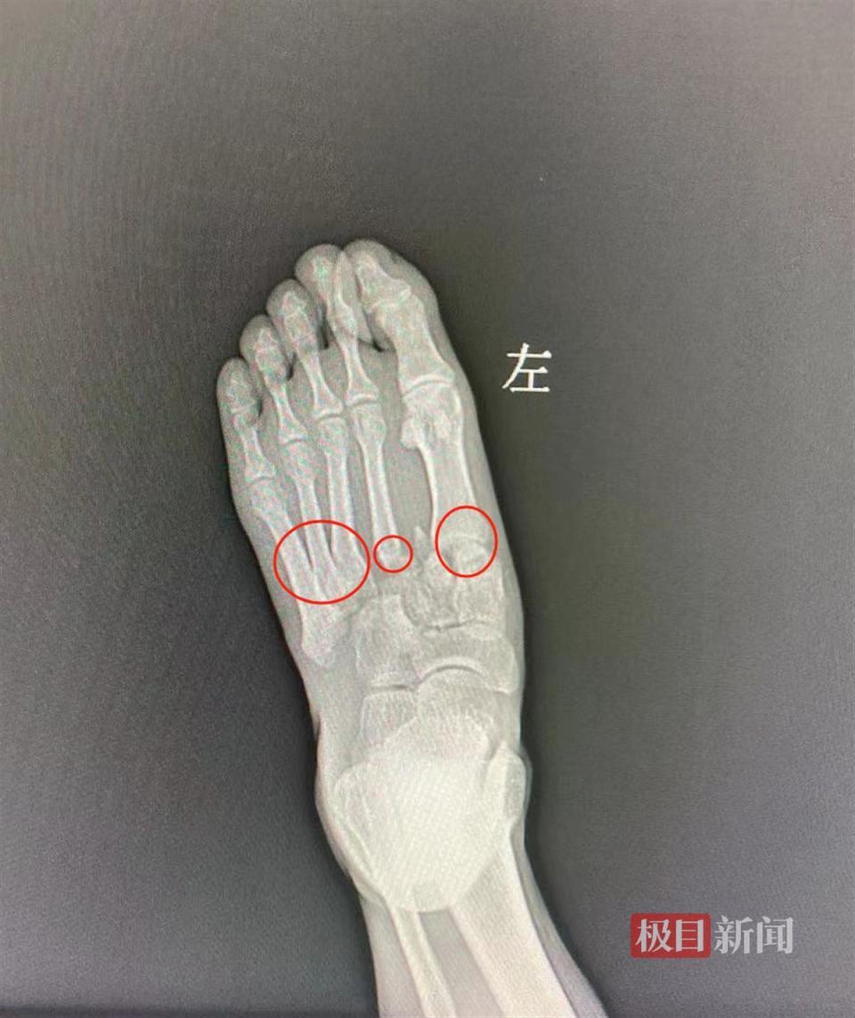 中心手术室,医生通过拼骨,复位,固定,成功保住了男子左脚足弓跗跖关节