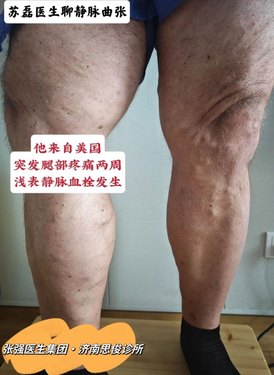 苏磊医生:静脉血栓容易盯上哪些人?