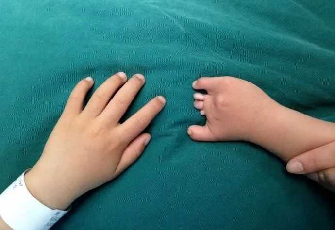 她是大小胸,左a右d,罪魁祸首原来是波兰综合征