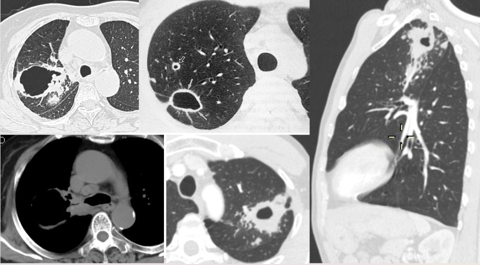 高莉教授:从呼吸科最常见的肺部感染基本影像,谈临床