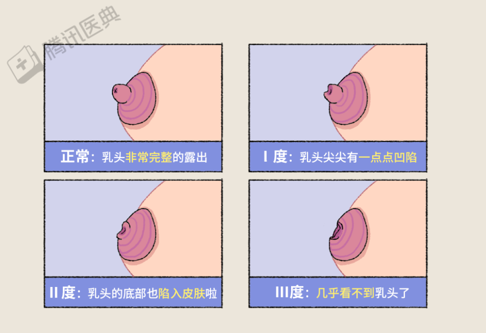 怀孕乳头突出图片