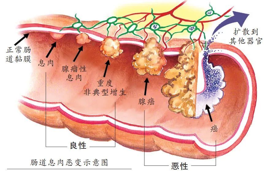 胃肠病学和肝脏病学》刊登的一篇综述指出,结直肠息肉分为腺瘤性,炎