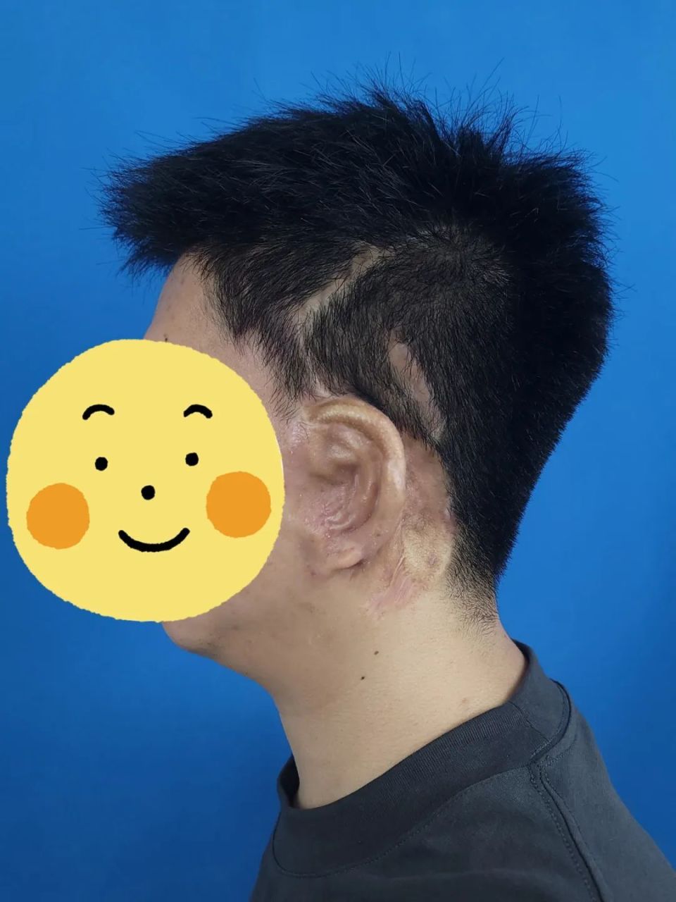 12年间多次手术未果求助逸仙团队,"小耳青年"在整形外科"圆梦"再造