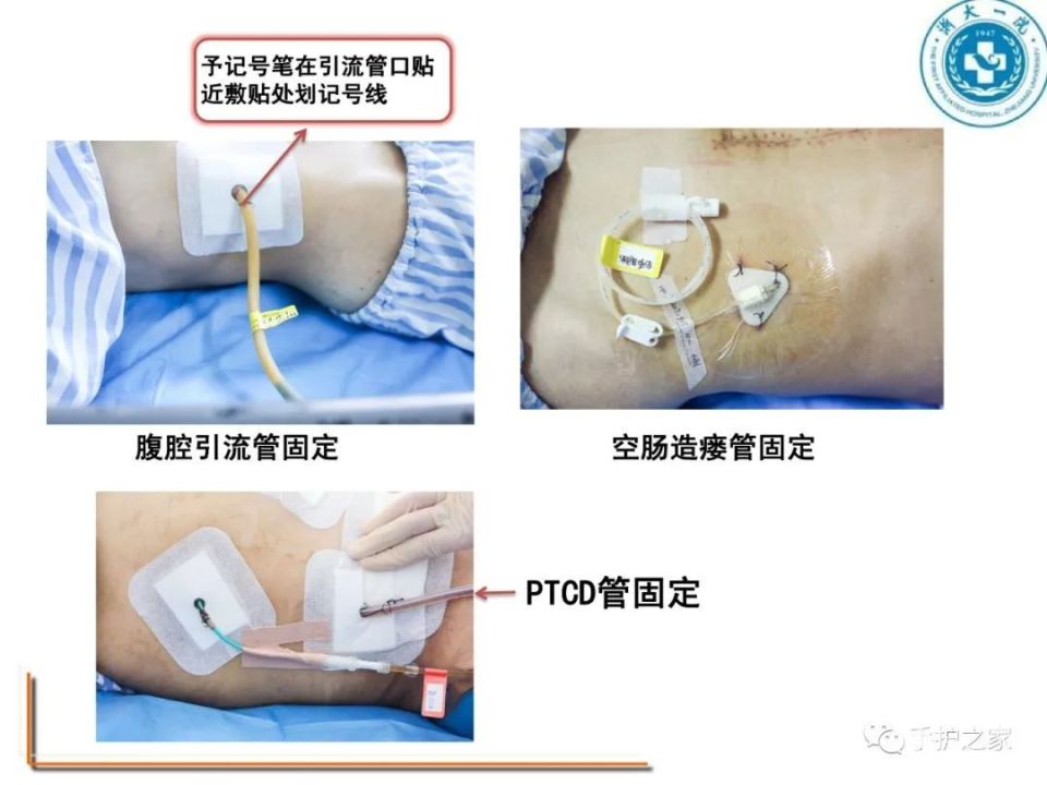 各类导管固定全攻略,一篇搞定!