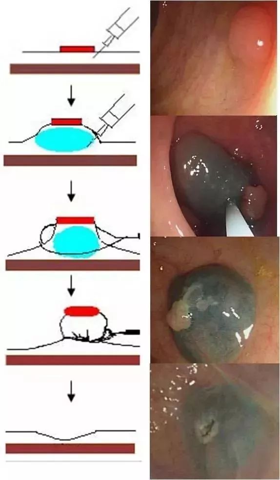 肠息肉切除过程图图片