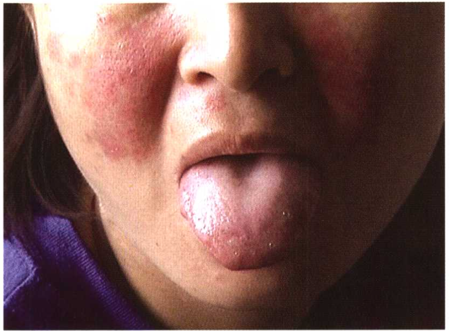 而系统性红斑狼疮的名字来源,是因患有此病的患者常出现的表现为面部