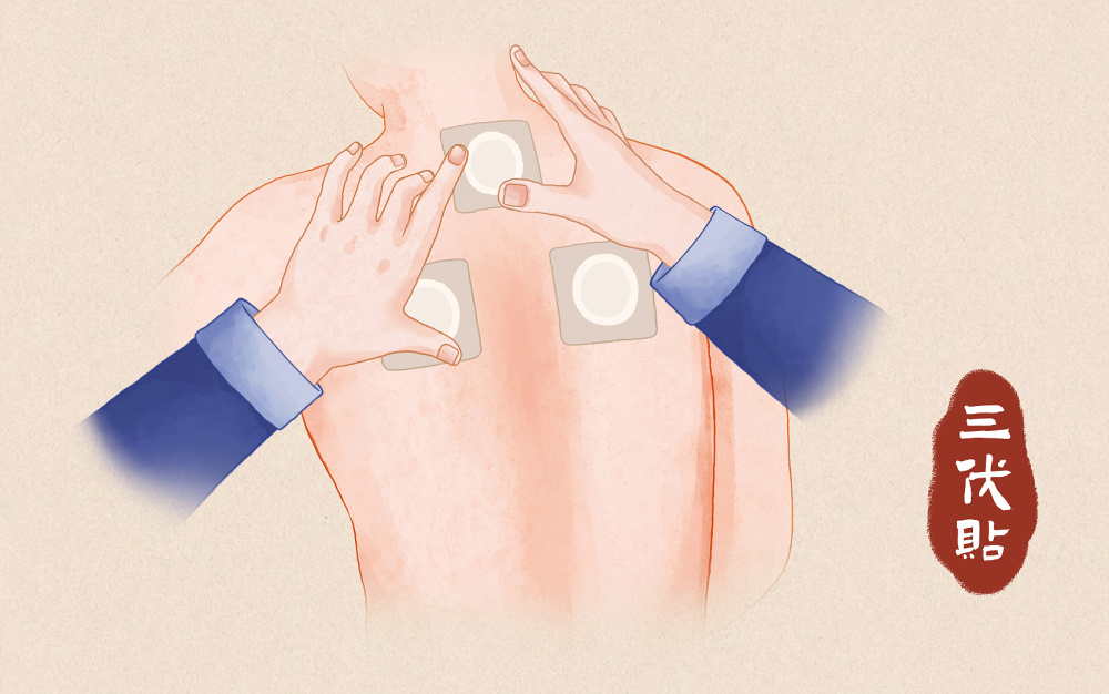 "三伏贴",是一种膏药,也是一种传统中医的治疗法,结合中医的针灸,经络