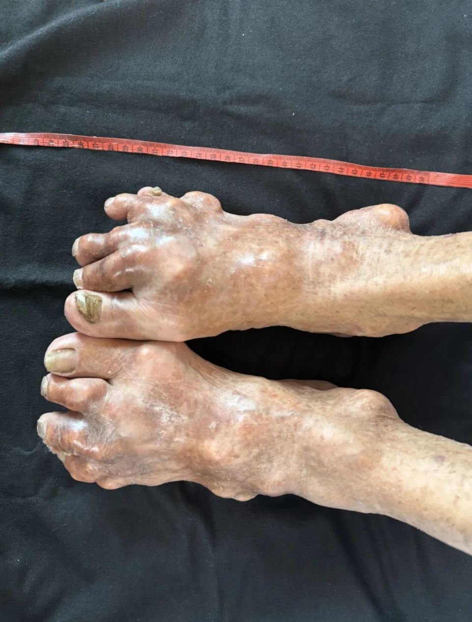 常年吃海鲜,老伯身上长满痛风石!手脚扭曲变形成"老姜" !