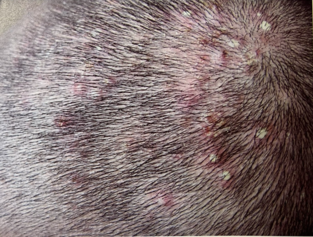 的样子看起来是一个个毛囊脓疱和毛囊红斑状丘疹,瘙痒是最常见的症状