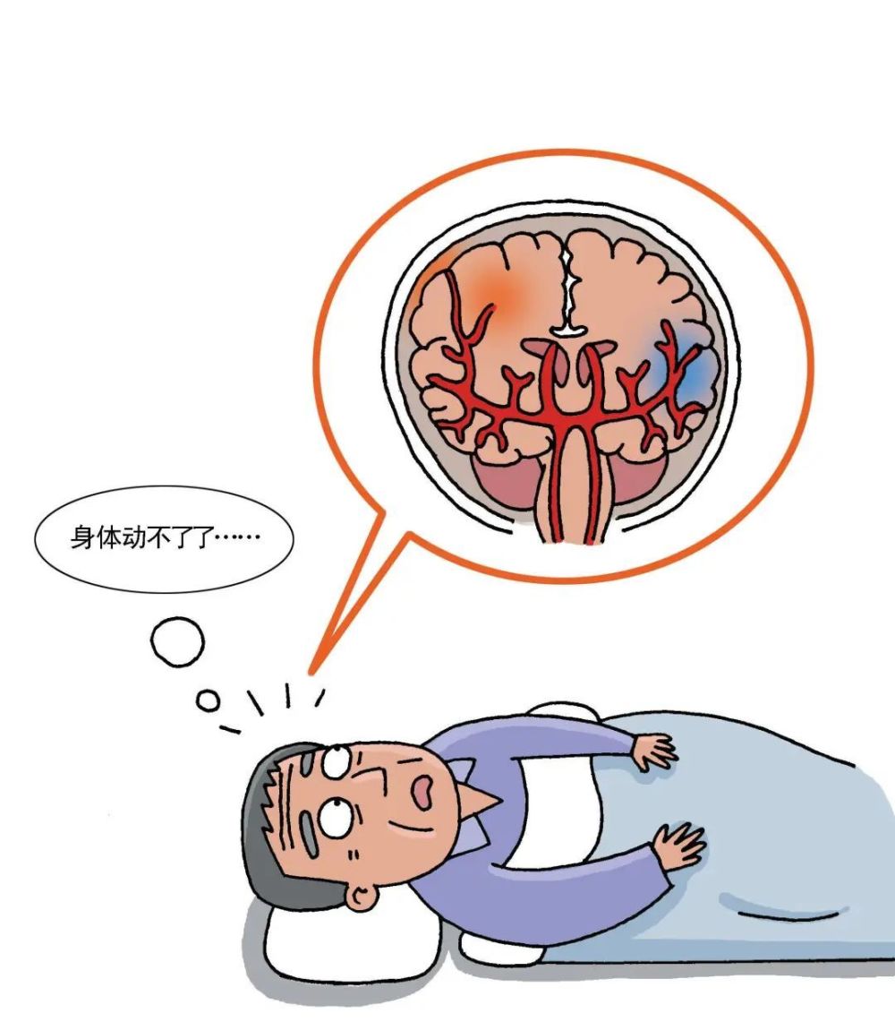 腦卒中盯上年輕人出現這些症狀要警惕健康總動員