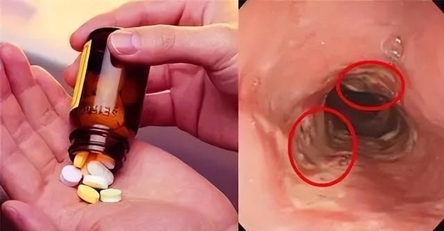 药源性食道炎好发于老年人及体弱多病者,口服药物进入胃部之前必须